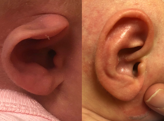 Ear Deformities in Newborns and Ear Molding