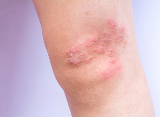 Psoriasis Explained by Phoenix Children’s Skin Care Experts