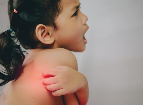 5 Tips to Prevent a Child’s Heat Rash