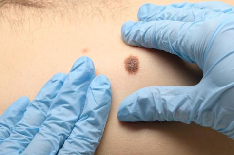 Skin Checks (and Melanoma) Aren’t Just for Adults