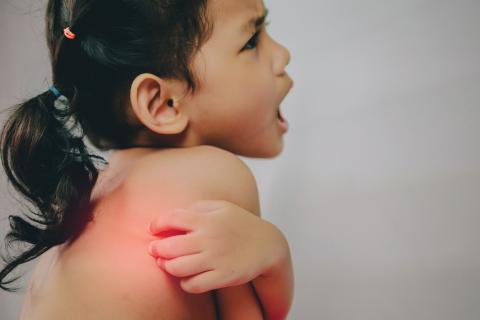 Baby Heat Rash: Symptoms, Prevention & Treatment