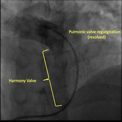 The Harmony Valve: Minimally Invasive Breakthrough Heart Care