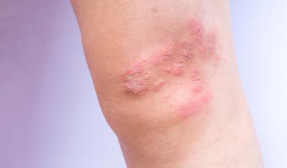 Psoriasis Explained by Phoenix Children’s Skin Care Experts