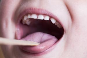 Tongue depressor in child's mouth