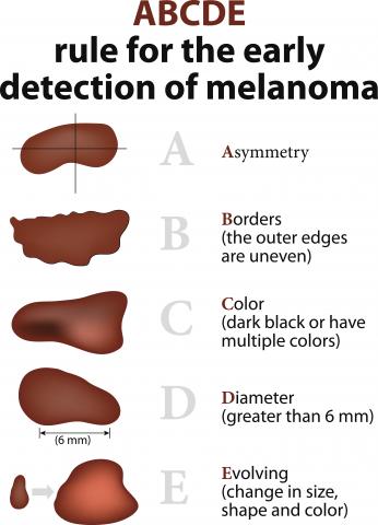 ABCDE Melanoma chart