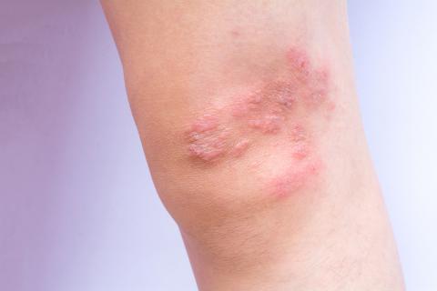 Psoriasis on patient's knee