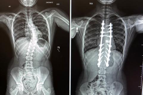 Before and After images of spine