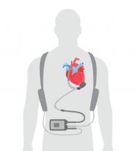 Illustration showing heart device in human body