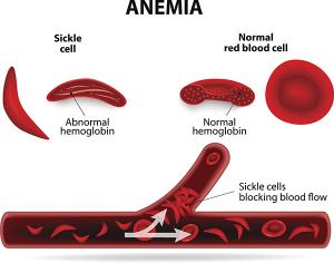 Image showing normal and sickle cell blood cells