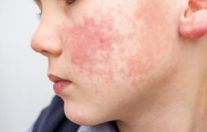 Closeup of rash on child's face