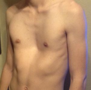 Photo of a teen's sunken chest
