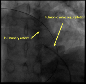 Radiology image of pulmonary artery