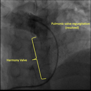 Radiology image of pulmonary artery with medical device