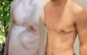 Before and After photos of chest deformity