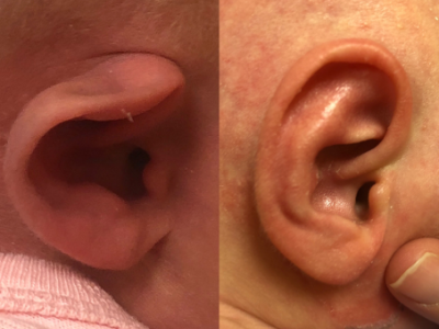 Before and After images of ear deformity