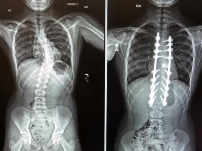 Before and After images of spine