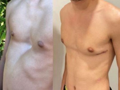 Before and After photos of chest deformity