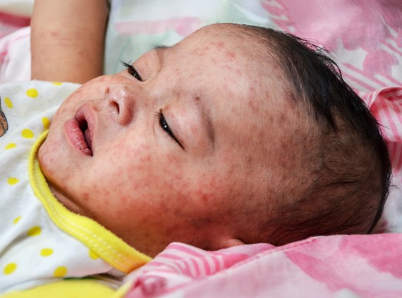 Baby with measles on face