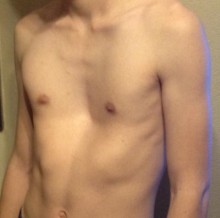 Photo of a teen's sunken chest