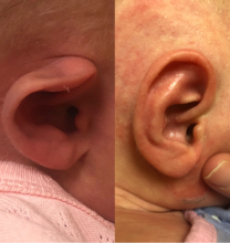 Before and After images of ear deformity