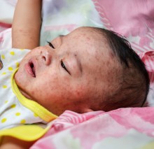 Baby with measles on face